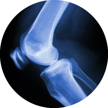knee x-ray image tyler welch md